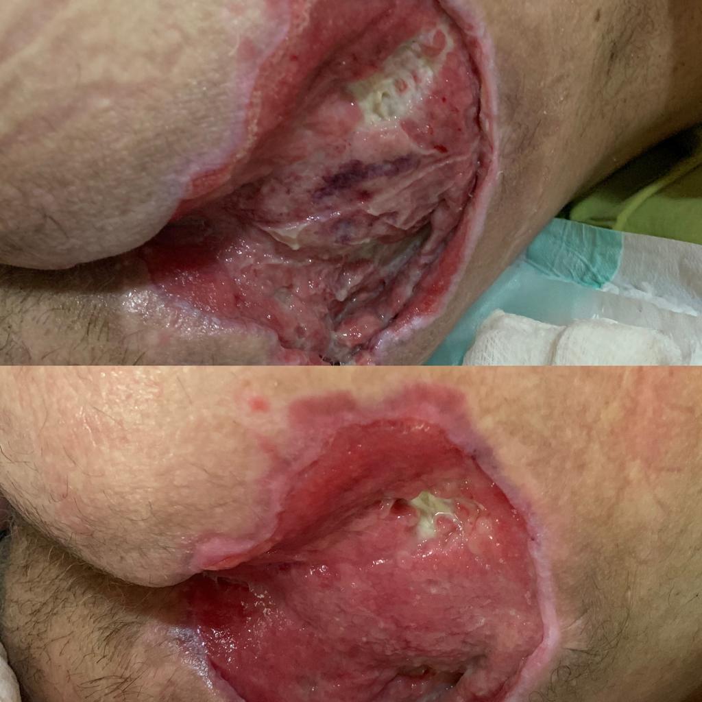 LESERTERAPIA NO TRATAMENTO DE ESCARAS DE REPOUSO 