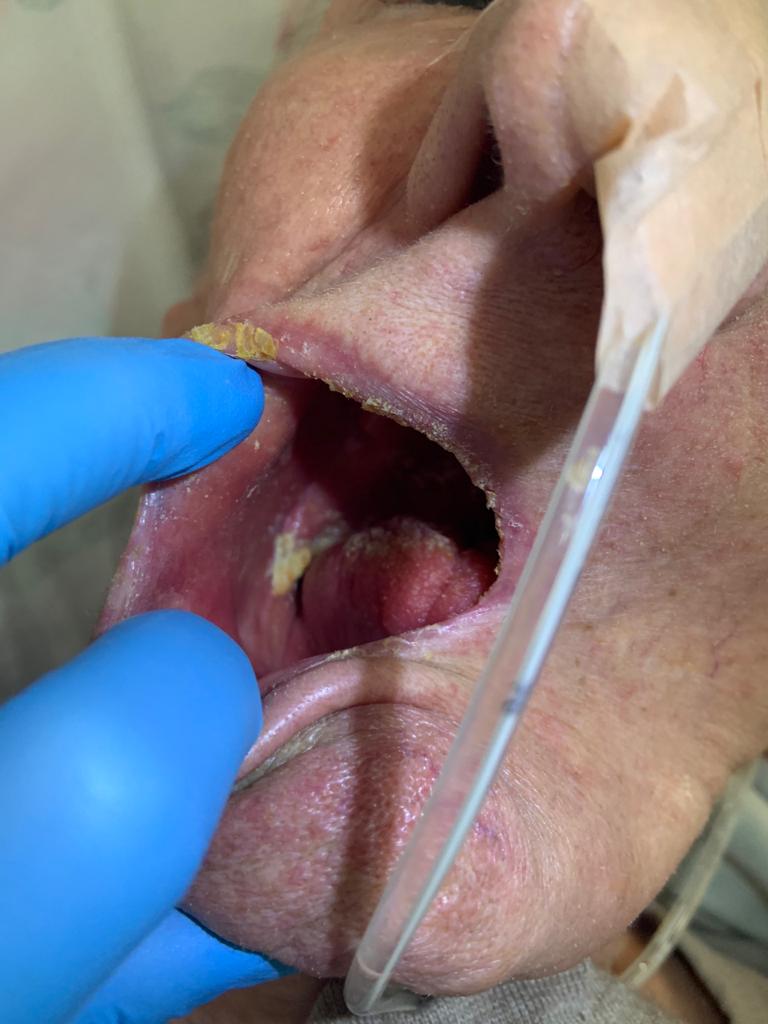 Candidíase Oral - Também conhecida como candidíase na boca, é uma infecção causada pelo excesso de fungo Candida albicans na boca, que causa infecção, geralmente, em bebês, devido a sua imunidade ainda pouco desenvolvida, ou em adultos com o sistema imune enfraquecido devido a gripes, doenças crônicas ou HIV, por exemplo. Apesar de habitar na pele, é possível que esse fungo prolifere e leve ao aparecimento de sinais e sintomas de infecção, como placas brancas na boca e dor e ardência na região. O tratamento para a candidíase oral deve ser feito com enxaguantes bucais, antifúngicos e correta higiene oral, devendo ser orientado por um clínico geral, dentista ou pediatra, no caso das crianças.                                