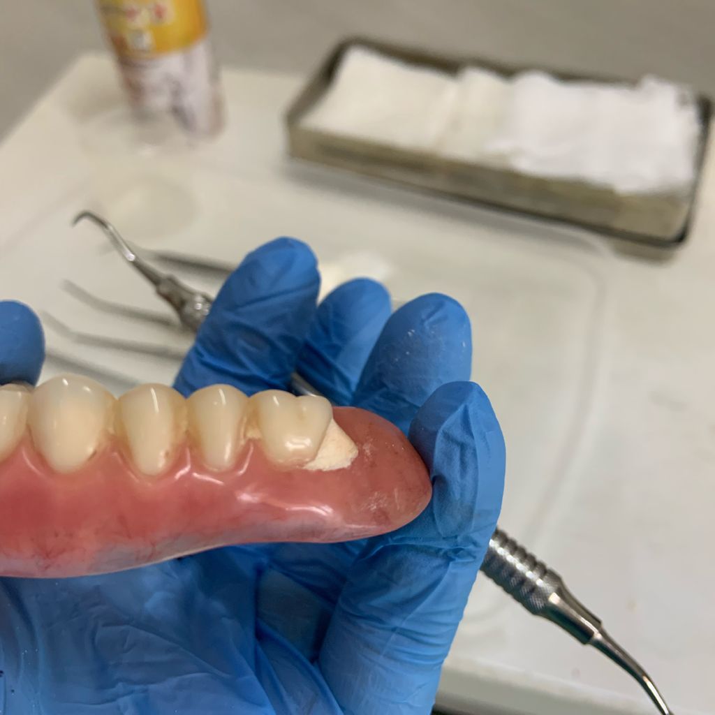 “PRÓTESES DENTÁRIAS TAMBÉM ACUMULAM TÁRTARO; POR ISSO, É IMPORTANTÍSSIMO QUE SEJA FEITA A HIGIENIZAÇÃO DAS MESMAS COM  PASTILHAS EFERVESCENTES PREVIAMENTE À ESCOVAÇÃO. A TÉCNICA É MUITO SIMPLES: COLOQUE A PRÓTESE NUM COPO COM ÁGUA E ACRESCENTE UMA PASTILHA DE LIMPEZA (INDICO A COREGA TABS); DEIXE EFERVESCER E APÓS ESTE PROCESSO, ESCOVE A PRÓTESE COM UMA ESCOVA APROPRIADA E DENTIFRÍCIO. ASSIM , E ELA ESTARÁ PRONTA PARA SER USADA NOVAMENTE.”