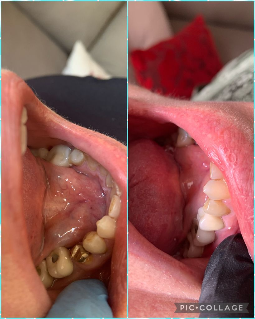 Mais dois trabalhos finalizados com sucesso num mesmo caso. Duas próteses fixas em porcelana; uma no primeiro molar superior esquerdo e outra no segundo pré molar inferior esquerdo. Mais um caso que resultou em sucesso e mais um paciente satisfeito, com a estética e a função mastigatória restabelecidas.