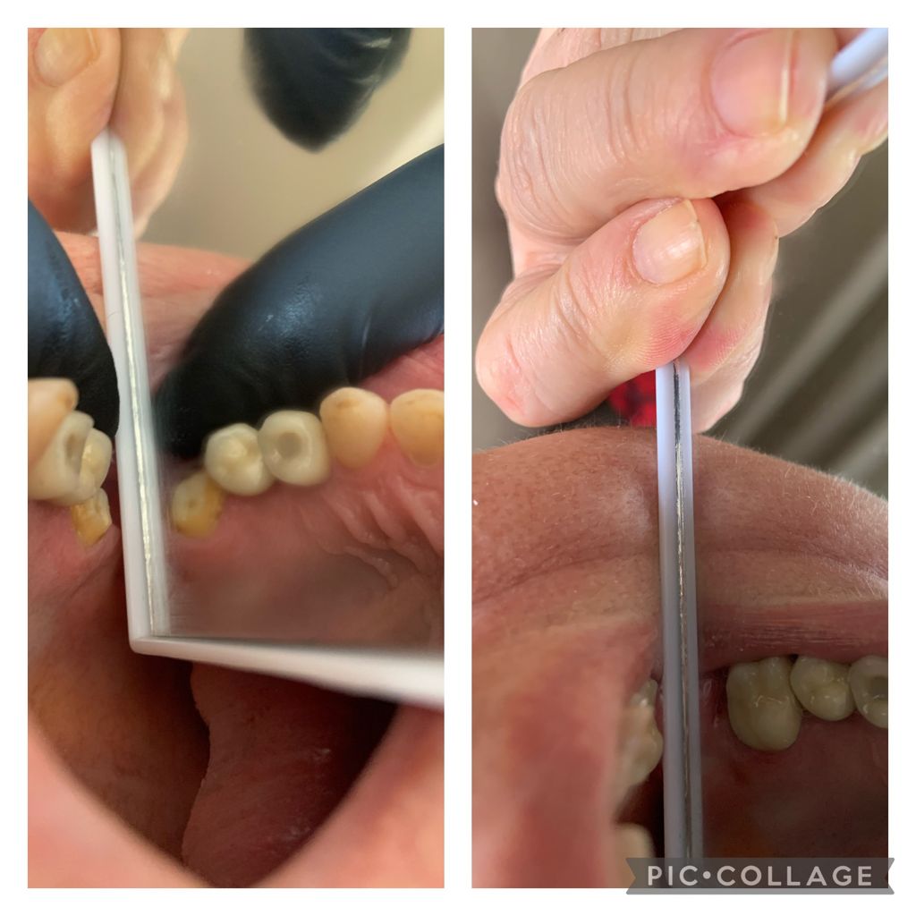 Mais dois trabalhos finalizados com sucesso num mesmo caso. Duas próteses fixas em porcelana; uma no primeiro molar superior esquerdo e outra no segundo pré molar inferior esquerdo. Mais um caso que resultou em sucesso e mais um paciente satisfeito, com a estética e a função mastigatória restabelecidas.