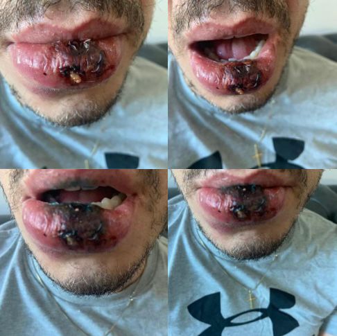 Fotos realizadas nos primeiros dias de laserterapia
