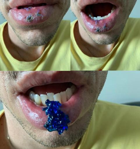 Fotos realizadas na 5ª sessão de laserterapia