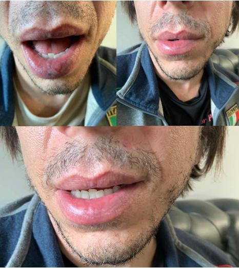 Fotos realizadas na 15ª sessão de laserterapia