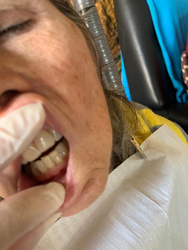 Limpeza realizada em paciente na casa de repouso em Hortolândia (Antes)